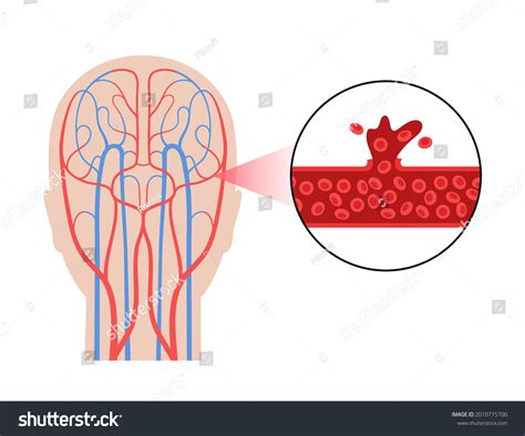 Hemorrhagic Brain Stroke Concept Apoplexy Cerebral Stock Vector Royalty Free 2010775700