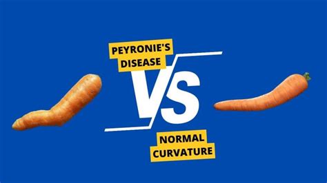 Peyronie S Disease Vs Normal Curvature Here S What You Should Know