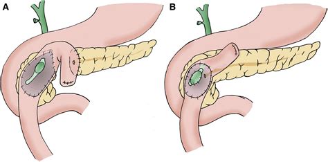 Duodenum Preserving Pancreatic Head Resection 10 Year Follow Up Of A Randomized Controlled