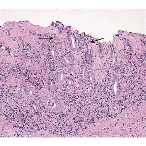 Endoscopic Photos Of The Body Of The Stomach Show Diffusely Nodular