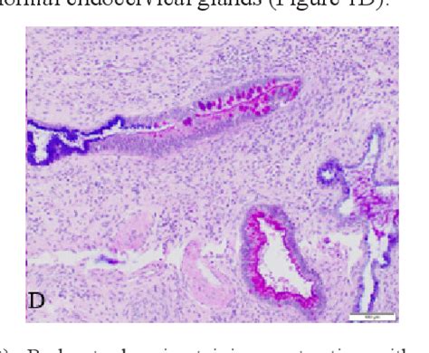 Figure From Gastric Type Adenocarcinoma In Situ Of The Uterine Cervix