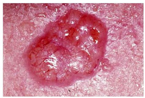 Skin Cancer Warning Signs Identifying Basal Cell Carcinoma Symptoms