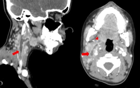 Lemierres Syndrome A Disguised Threat Bmj Case Reports