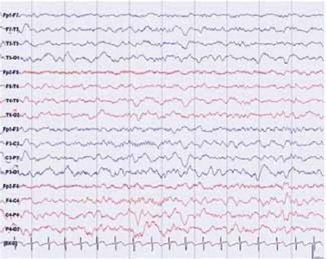 Ten Seconds Eeg Epoch Sleep Record At 5 Months Age Shows A Normal