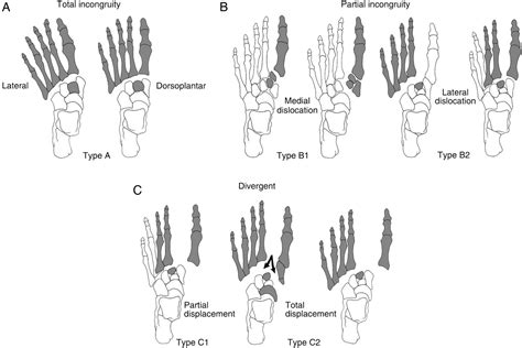 Lisfranc Fracture Dislocation A Review Of A Commonly Missed Injury Of