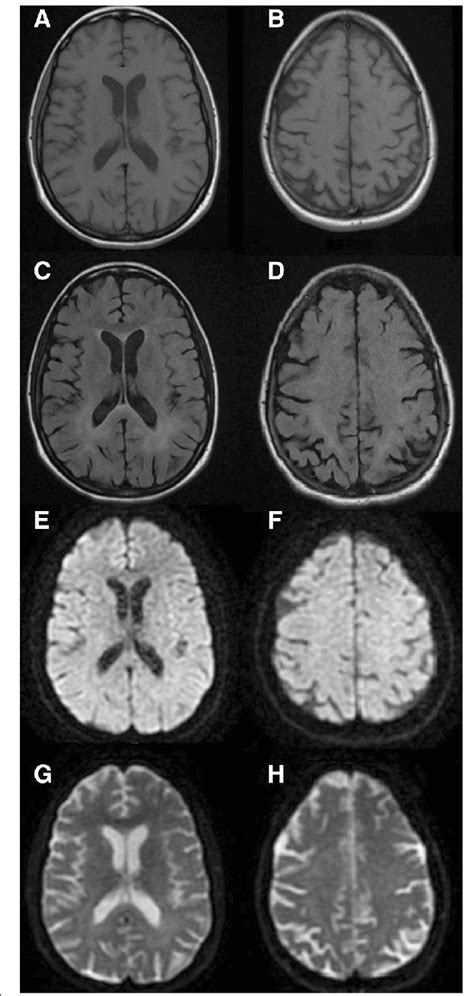 Brain MRI Axial T1 A B T2 FLAIR C D DWI E F And ADCmap G H