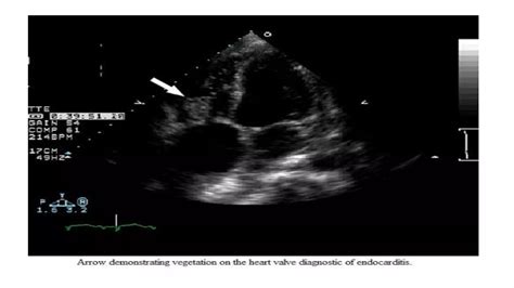 Infective Endocarditis Echocardiography Ppt