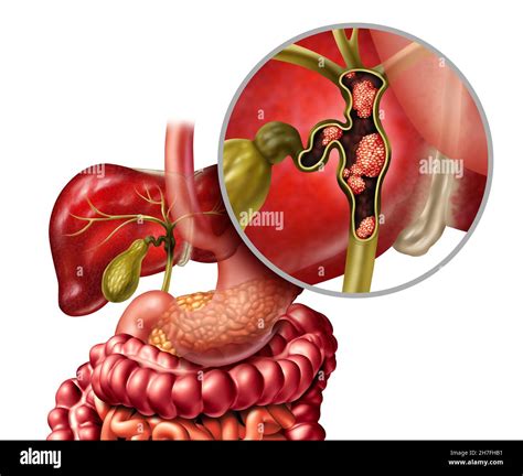 Cáncer de las vías biliares o colangiocarcinoma con vesícula biliar e