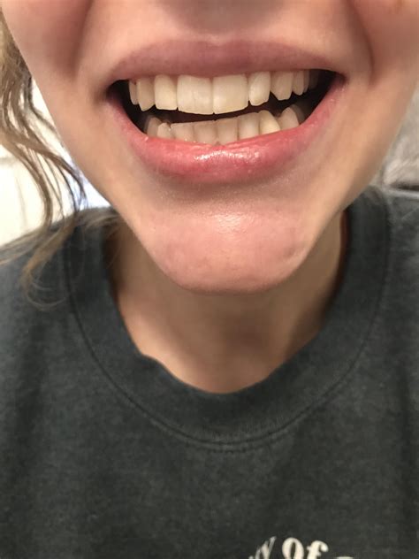 Symptoms Worseningbite Off Teeth Slanted Facial Asymmetry What Now Rtmj