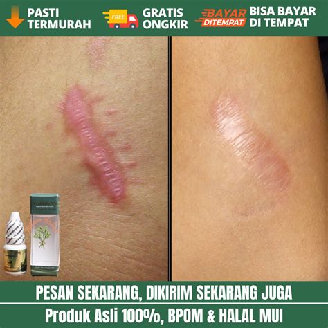 Jual Propolis Sm Obat Penumpas Daging Jadi Obat Penumpas Daging