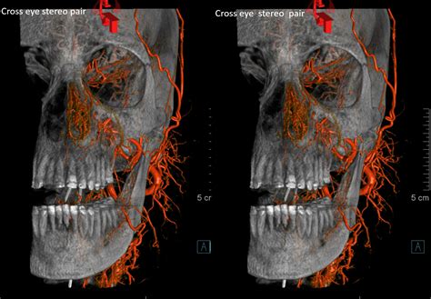 Facial Artery