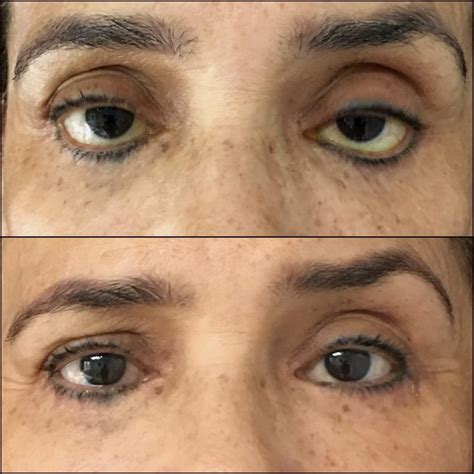 Revision Blepharoplasty Before And After Photos Flora Levin Md