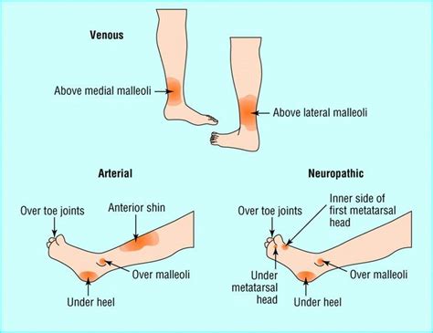 Venous And Arterial Ulcers Wound Care Nursing Community Nursing