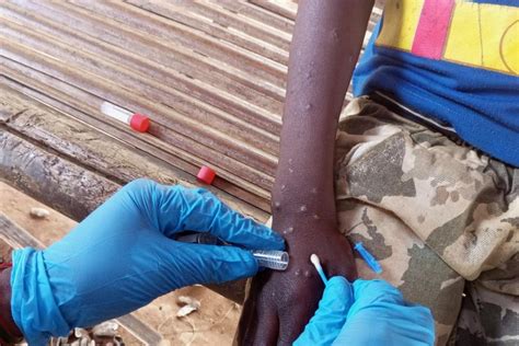 Iom Appeals For Usd 185 Million To Urgently Aid Mpox Affected