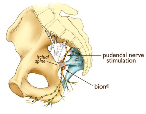 Figure Schematic Placement Of Bion Implant For Pudendal Nerve