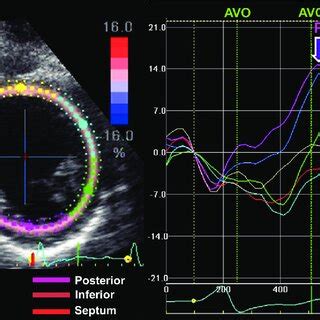 An Example Of Radial Strain From Speckle Tracking Imaging Of The