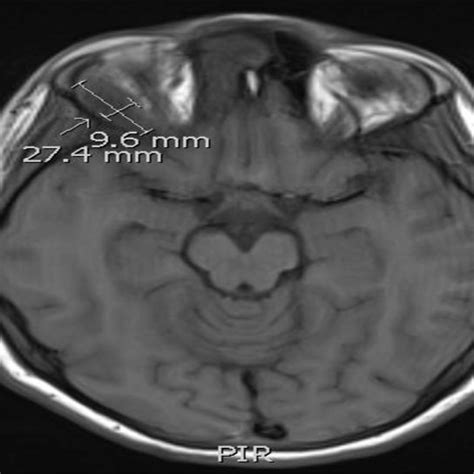 c): Cerebral MRI-sagittal view frontal epidural abscess (4.4 cm x 3.7cm... | Download Scientific ...