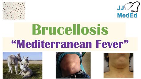 Brucellosis Mediterranean Fever Transmission Pathogenesis Symptoms Diagnosis Treatment