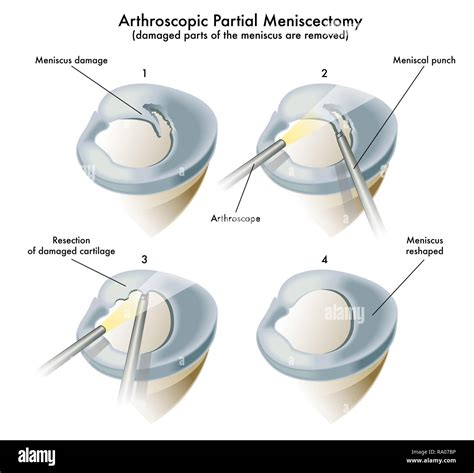 Medical Illustration Of An Operation Of A Arthroscopic Partial