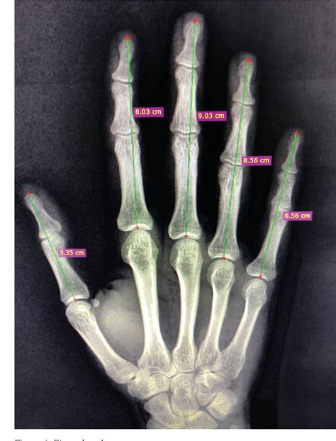 Figure 1 from An attempt to gender determine with phalanx length and ...