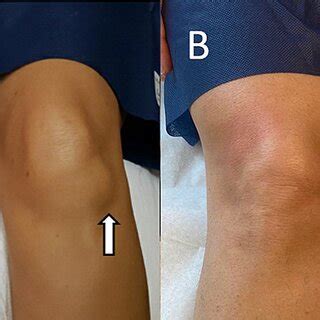 A Preinjection Knee Showing Ganglion Cyst Arrow B Postinjection