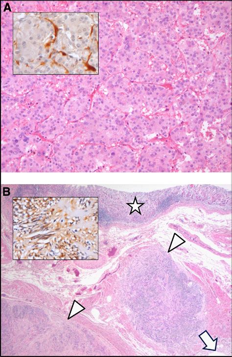 Pheochromocytoma And Gastrointestinal Stromal Tumors In Patients With Neurofibromatosis Type I