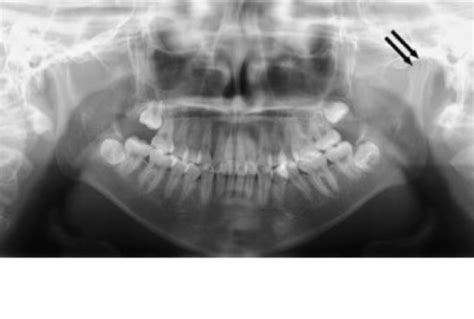 Clinical Imaging Tmj Flashcards Quizlet