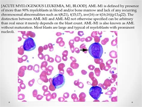 Acute Myeloid Leukemia Online Presentation