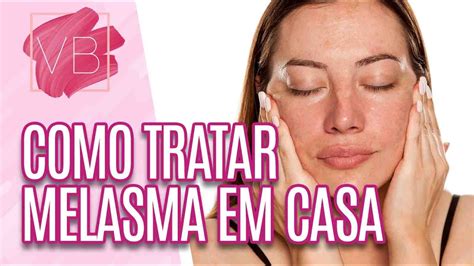 Saiba Como Tratar Melasma Em Casa Voc Bonita Youtube