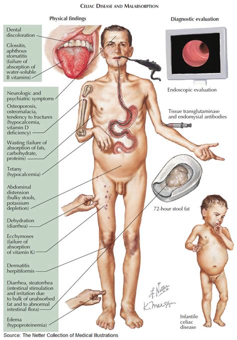 Manual Of Medicine On Twitter Celiac Disease And Malabsorption