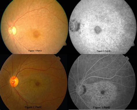 The Ocular Fundus Photographs And Fundus Fluorescein Angiography Ffa