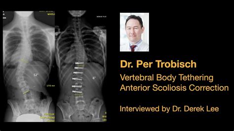 Dr Per Trobisch Vertebral Body Tethering Asc Non Fusion Scoliosis Surgery With Dr Derek Lee