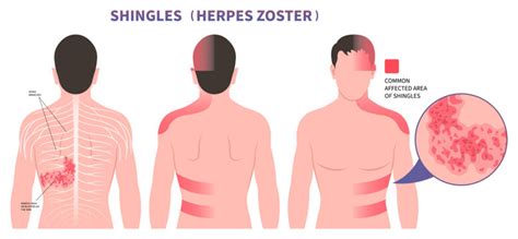 Meningitis Rash Early Stages