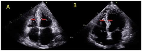 Jcdd Free Full Text Interventricular Septal Involvement Is