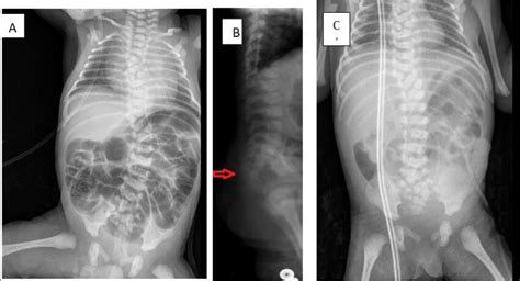 -(A) Anterior view X-ray at day of birth showed dilated large and small ...