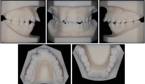 Figure 1 From Vertical Control Of A Severe Hyperdivergent Skeletal Class Ii Malocclusion With