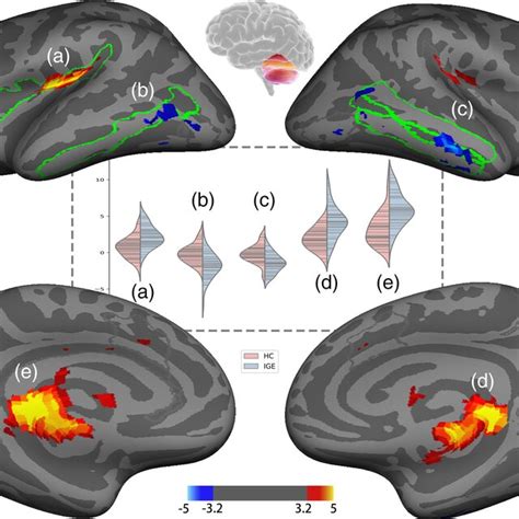 The Aberrant Basal Ganglia Bg‐thalamocortical Functional Connectivity