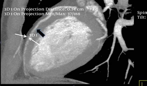 Systolic Compression Of A Myocardial Bridged Coronary Artery And Its