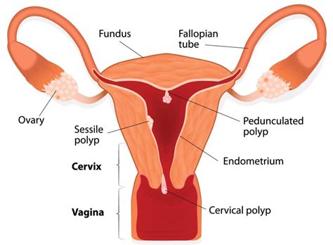 Polyps Fibroids Or Cysts Whats The Difference