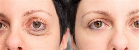 Lower Eyelid Blepharoplasty Long Beach Cosmetic Procedures Ca