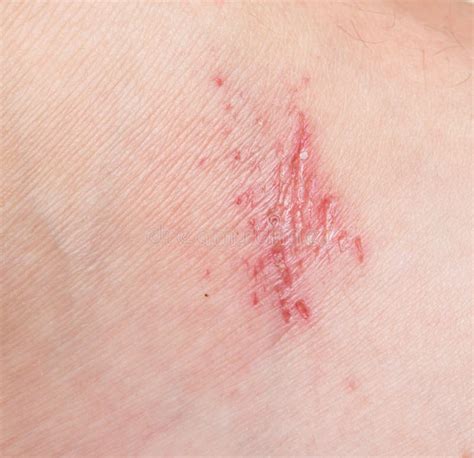 Wound On Skin Stock Photo Image Of Knee Scar Injury