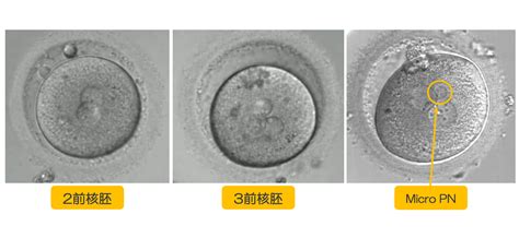 Micro Pnを含む3pn胚の形態学的所見と培養成績の解析【第25回日本ivf学会】 浅田レディースクリニック東京品川・愛知