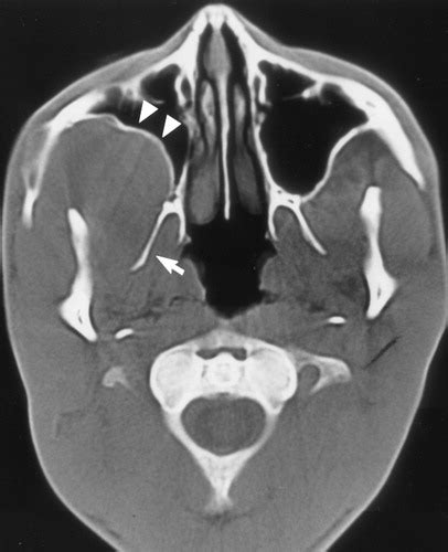 Pterygoid Plate Radiograph