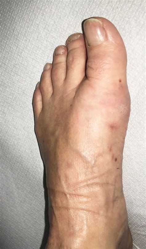 Hallux Valgus Dr Michael Vitek Wien