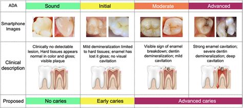 Taxonomy Of Dental Caries Download Scientific Diagram