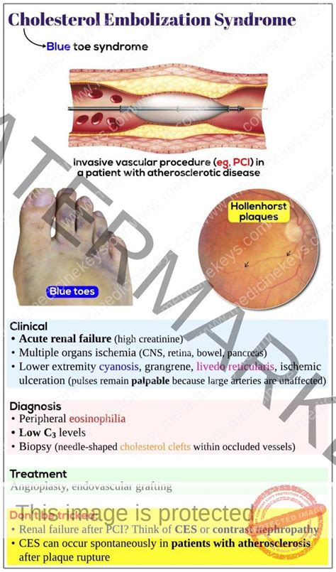 Cholesterol Embolization Syndrome Medicine Keys For Mrcps