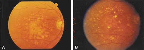 Patient A Drusenoid Type Of Retinal Pigment Epithelial Detachment