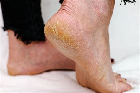 How To Remove Thick Dead Skin From Feet Without Pumice Stone A