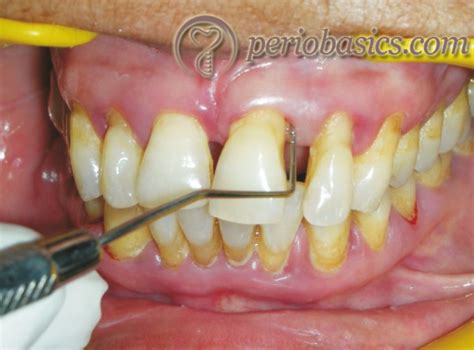 Periodontal Pocket