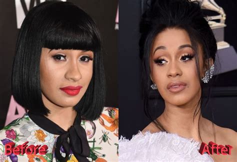 Cardi B Plastic Surgery A New Look For A New Life